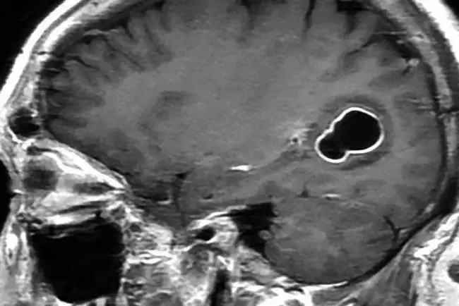 Desarrollan chip con IA; permite comunicarse a pacientes con parálisis cerebral