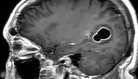 Desarrollan chip con IA; permite comunicarse a pacientes con parálisis cerebral