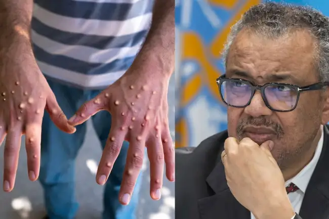 Pide la OMS respuestas sobre mpox pero sin pánico