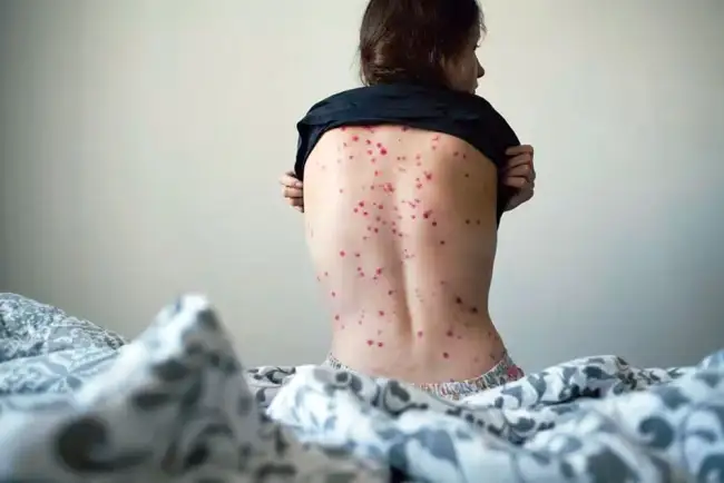 Detectan peligrosa variante de viruela del mono en Tailandia