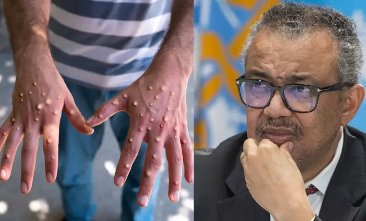 Pide la OMS respuestas sobre mpox pero sin pánico