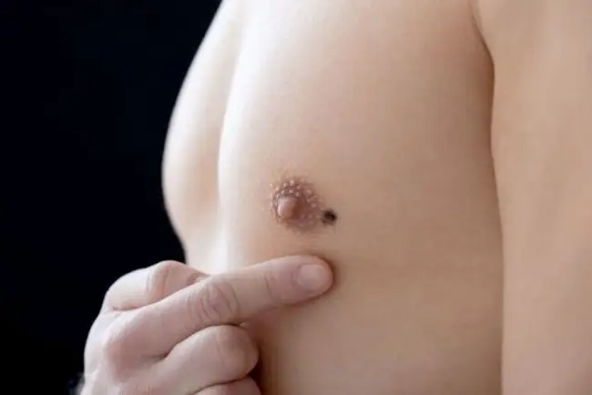 Hoy 7 de octubre se conmemora Día Mundial del Hombre con Cáncer de Mama