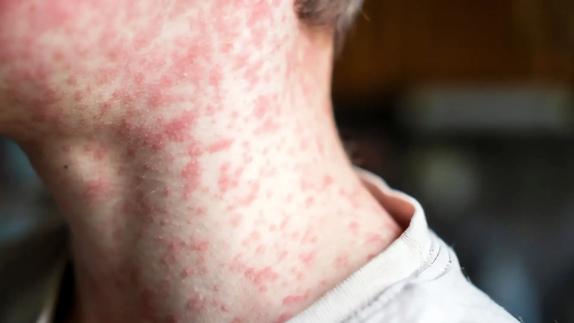 Muere la primera persona en México por brote de sarampión
