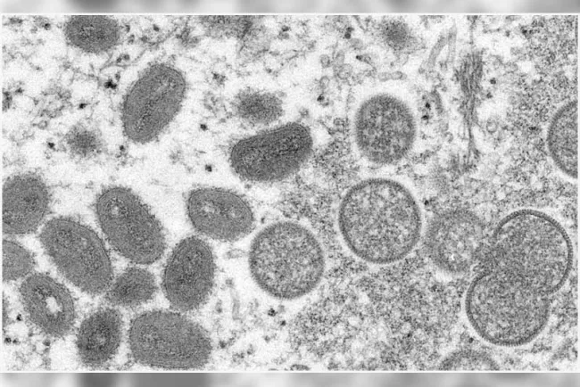 Confirman primer caso de viruela del mono en América Latina