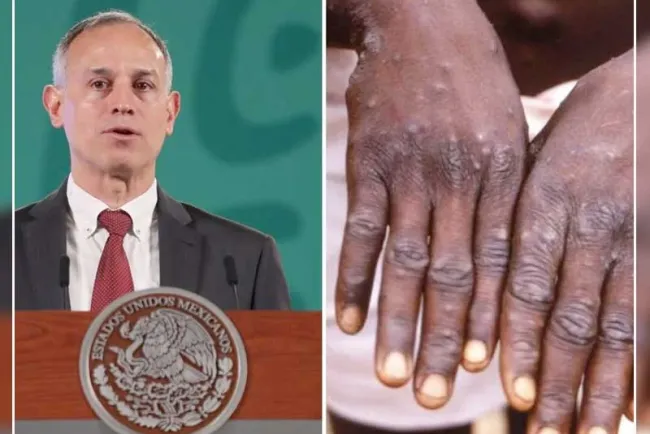 Esto es lo que se sabe del primer caso de viruela del mono en México
