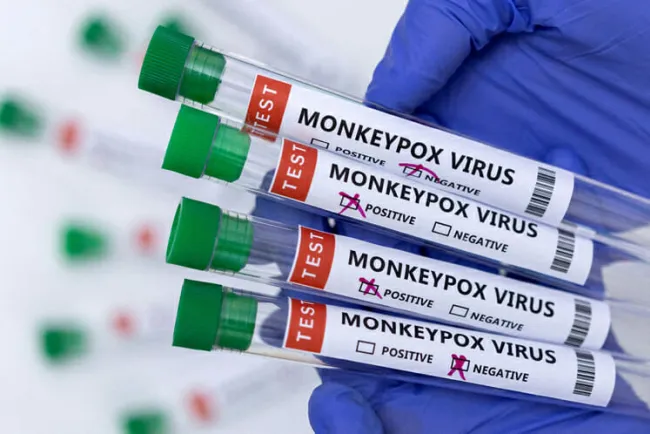 Muere paciente infectado con viruela del mono en EU