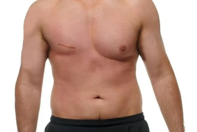 Hombres pueden padecer cáncer de mama a partir de los 50 años