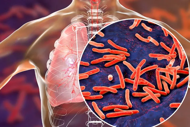 Tuberculosis vuelve a propagarse en el mundo: OMS