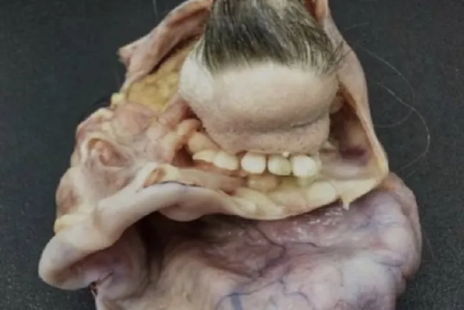 Extraen tumor con pelos y dientes de mujer