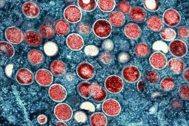 Renombre OMS a viruela del mono como “mpox”