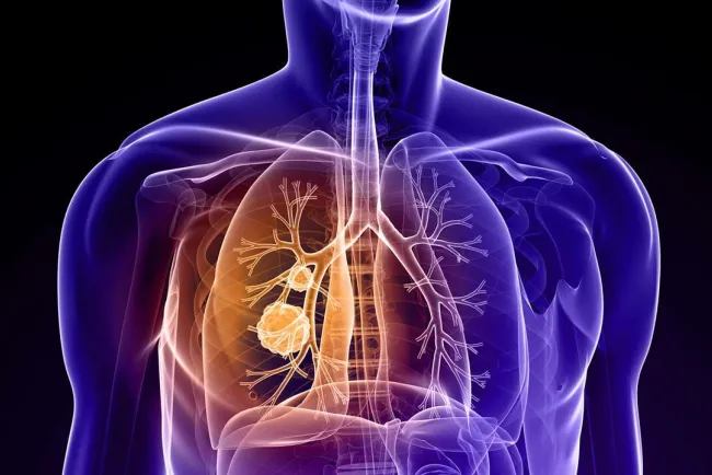 Autoriza FDA medicamento contra cáncer de pulmón