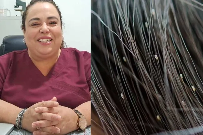 Explica experta como prevenir los piojos en verano y en invierno