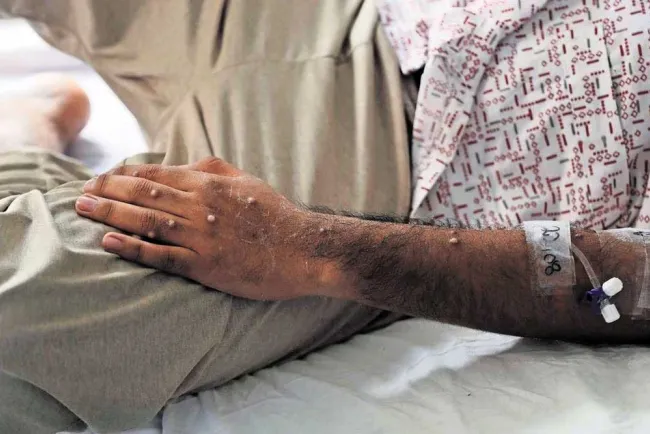 Levanta OMS emergencia por viruela símica