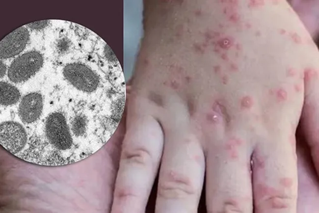 Levanta OMS alerta máxima por brote de la viruela del mono