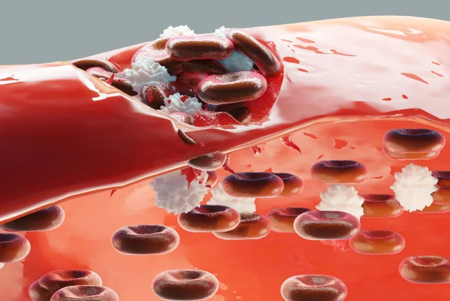 Atiende IMSS al 59% de pacientes que sufren hemofilia