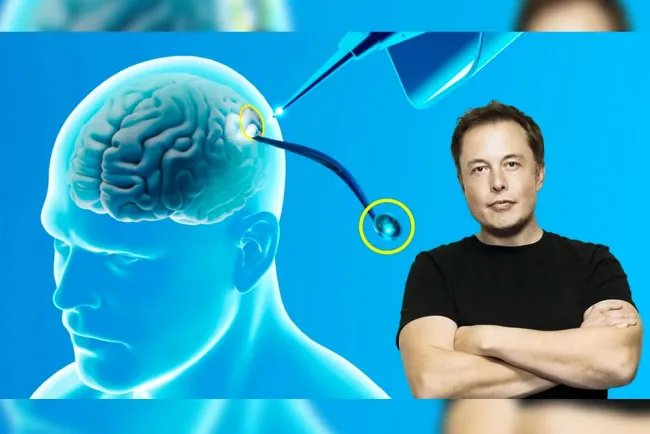 Implantan primer chip cerebral con Neuralink