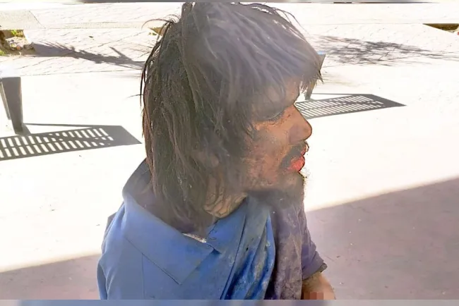 Hombre atropellado pierde mano y se niega a atención médica