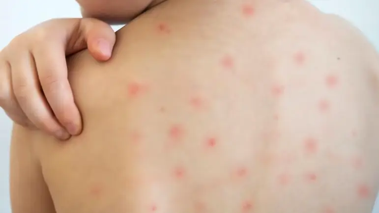 Brote de sarampión en México: 362 casos y una muerte
