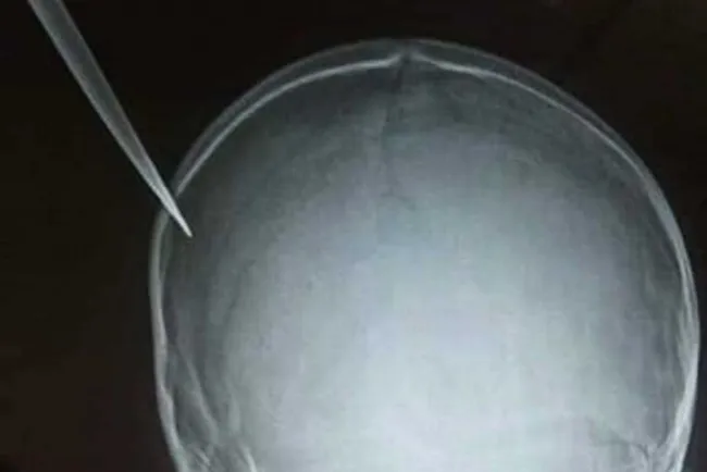 Menor de siete años apuñala niño de cinco en la cabeza