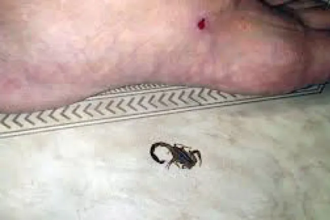 Llaman a evitar remedios caseros