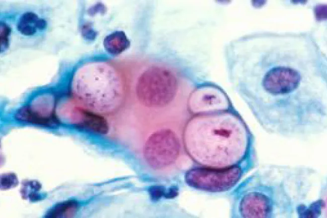 Aumentan enfermedades venéreas