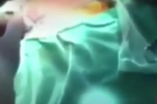 Pese a sismo de 7.5, cirugía a corazón abierto sigue adelante