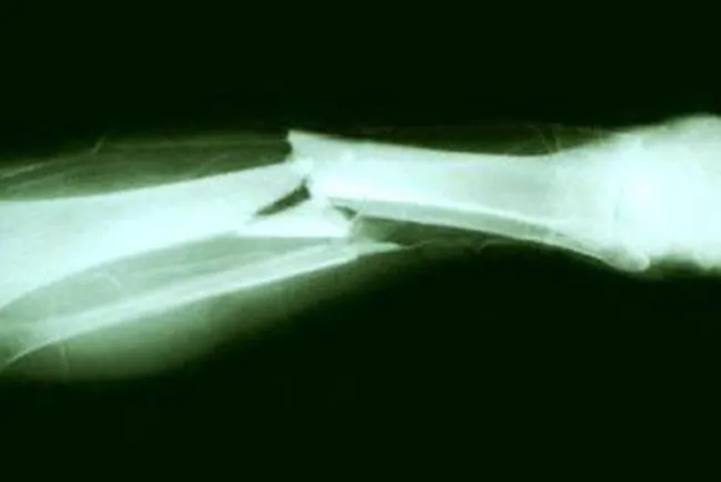 Streamer se rompe la pierna y no deja de transmitir para sus seguidores