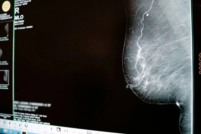 Cáncer de mama: Autoexplórate, esta práctica puede salvar tu vida