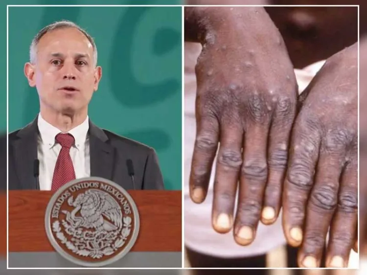 Esto es lo que se sabe del primer caso de viruela del mono en México