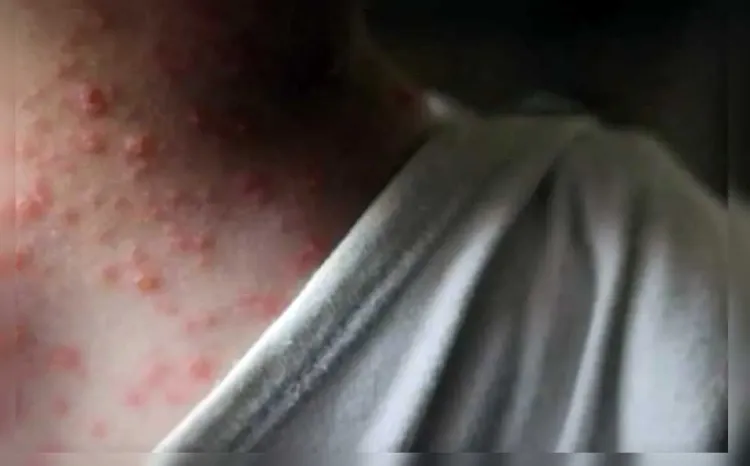 Suma México 60 casos de viruela del mono