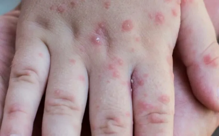 Aumentan casos de viruela en México