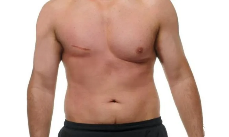 Hombres pueden padecer cáncer de mama a partir de los 50 años