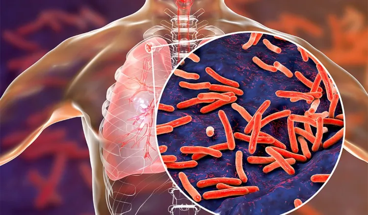 Tuberculosis vuelve a propagarse en el mundo: OMS