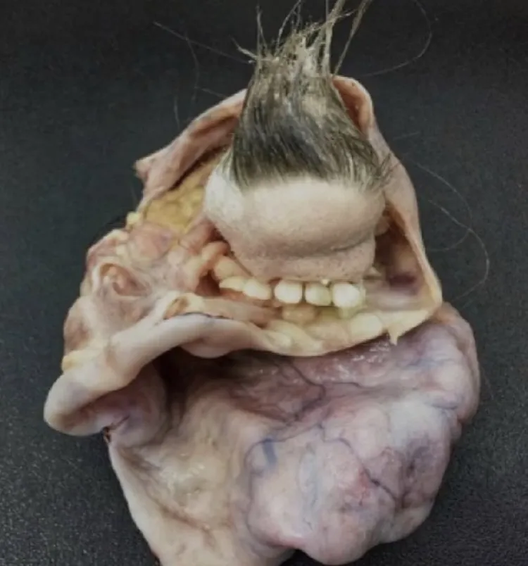 Extraen tumor con pelos y dientes de mujer