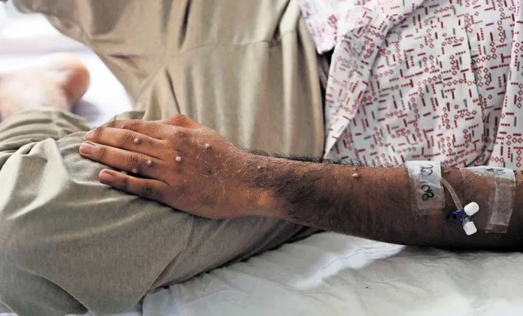 Levanta OMS emergencia por viruela símica