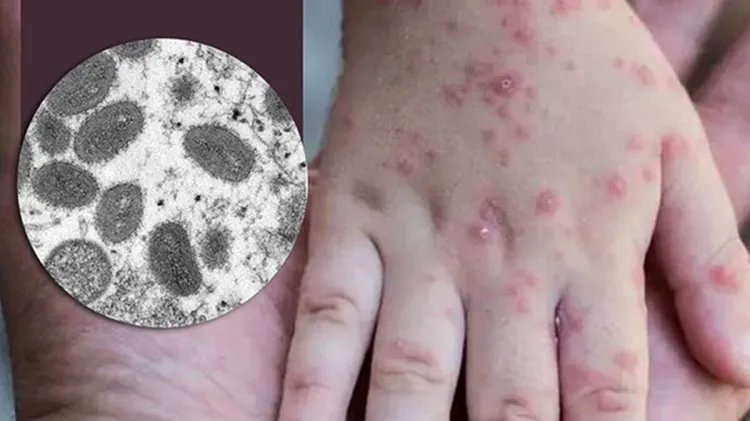 Levanta OMS alerta máxima por brote de la viruela del mono