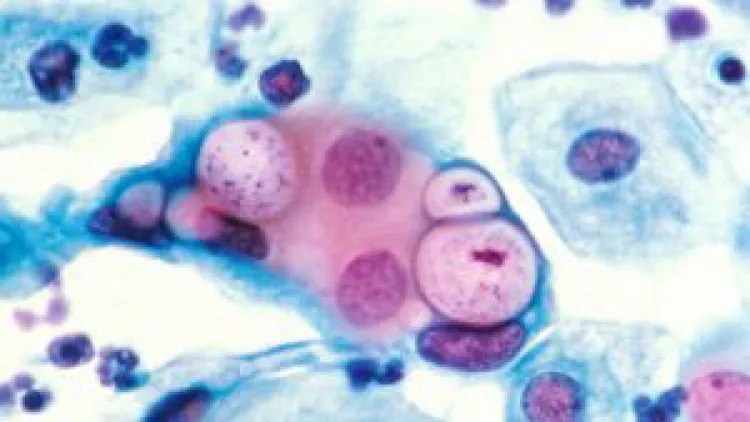 Aumentan enfermedades venéreas