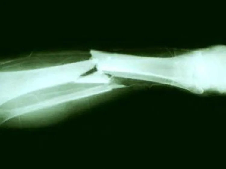 Streamer se rompe la pierna y no deja de transmitir para sus seguidores