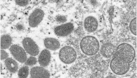 Confirman primer caso de viruela del mono en América Latina