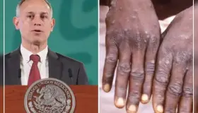 Esto es lo que se sabe del primer caso de viruela del mono en México
