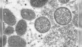 Ve OMS improbable que viruela del mono pase a ser pandemia