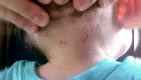 Alertan por casos de Rickettsia en esta frontera