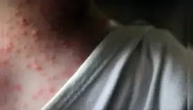 Suma México 60 casos de viruela del mono