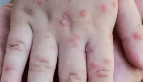 Aumentan casos de viruela en México