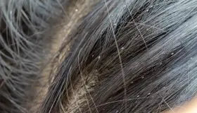 Llaman a prevenir la proliferación de piojos en niños