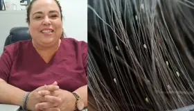 Explica experta como prevenir los piojos en verano y en invierno