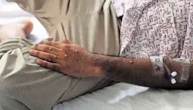 Levanta OMS emergencia por viruela símica