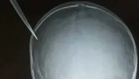 Menor de siete años apuñala niño de cinco en la cabeza