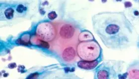 Aumentan enfermedades venéreas