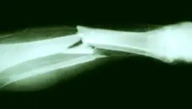 Streamer se rompe la pierna y no deja de transmitir para sus seguidores